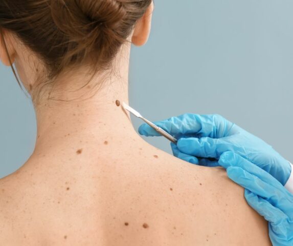 Semaine Nationale du Dépistage du Cancer de la Peau